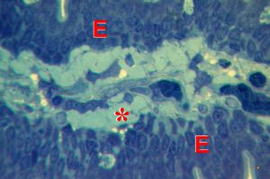M,60y. | jejunum - amyloidosis(semithin section)